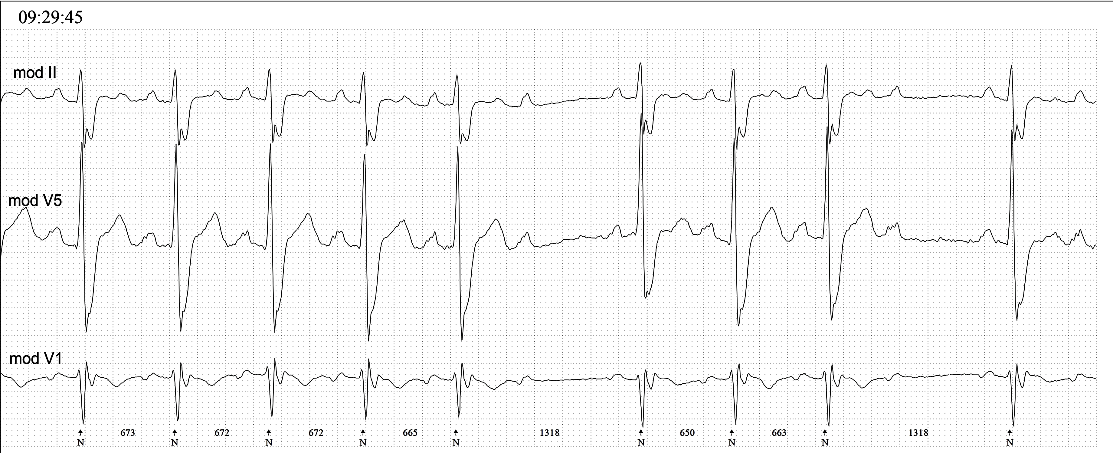 Seconddegree AV block Type II ECG Guru Instructor Resources